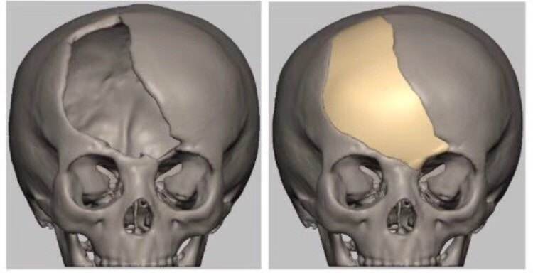 <b>颅骨缺损修复是一种什么样的手术</b>