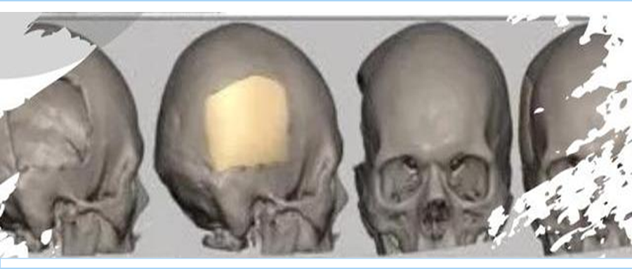 <b>颅骨修复手术后常出现的问题</b>