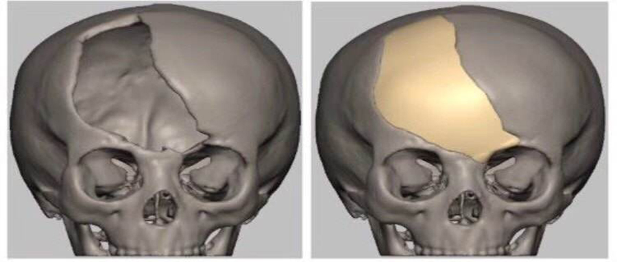<b>颅骨修复二次手术费用是多少</b>