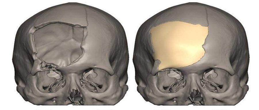 <b>创伤性颅骨缺损对大脑恢复的帮助</b>