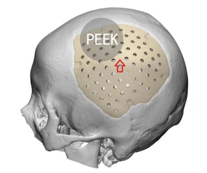 <b>颅骨修复钛网和PEEK哪个好</b>
